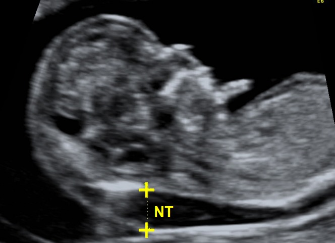 NT Scan (Nuchal Translucency) - As close to 13w as possible
